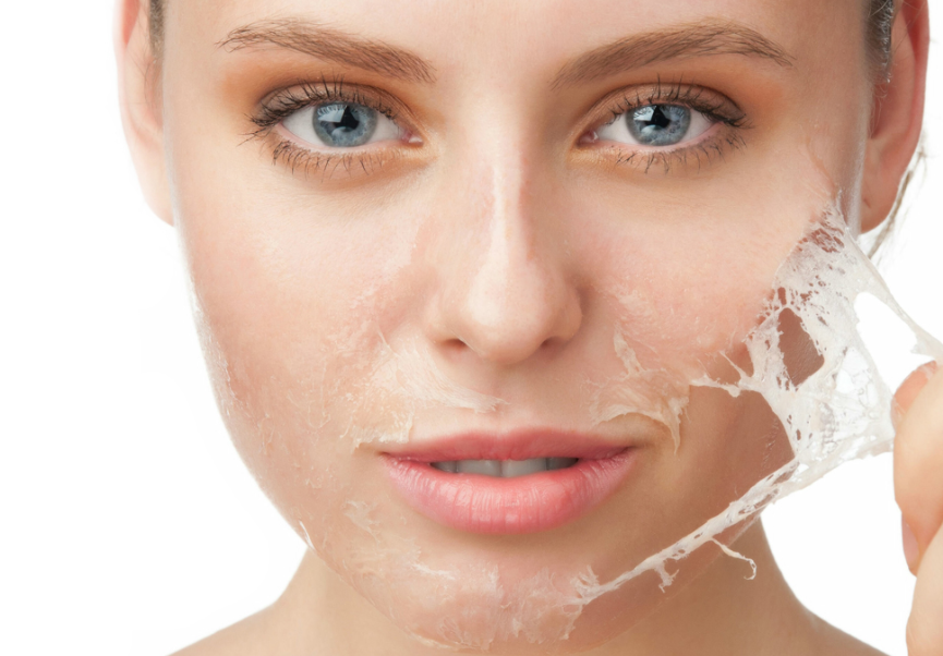 Kimyasal Peeling